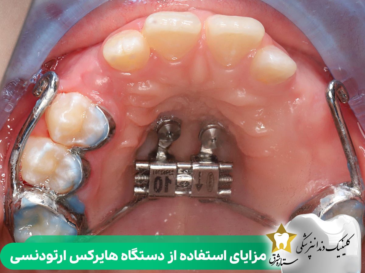 مزایای استفاده از دستگاه هایرکس 