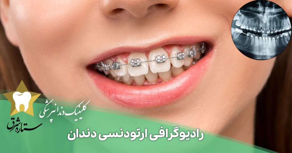 رادیوگرافی ارتودنسی دندان