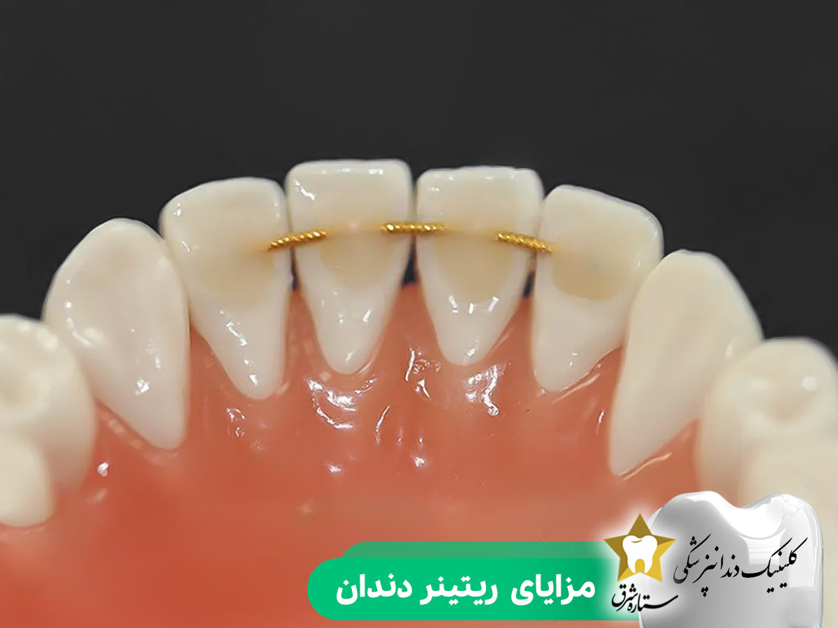 مزایای ریتینر دندان