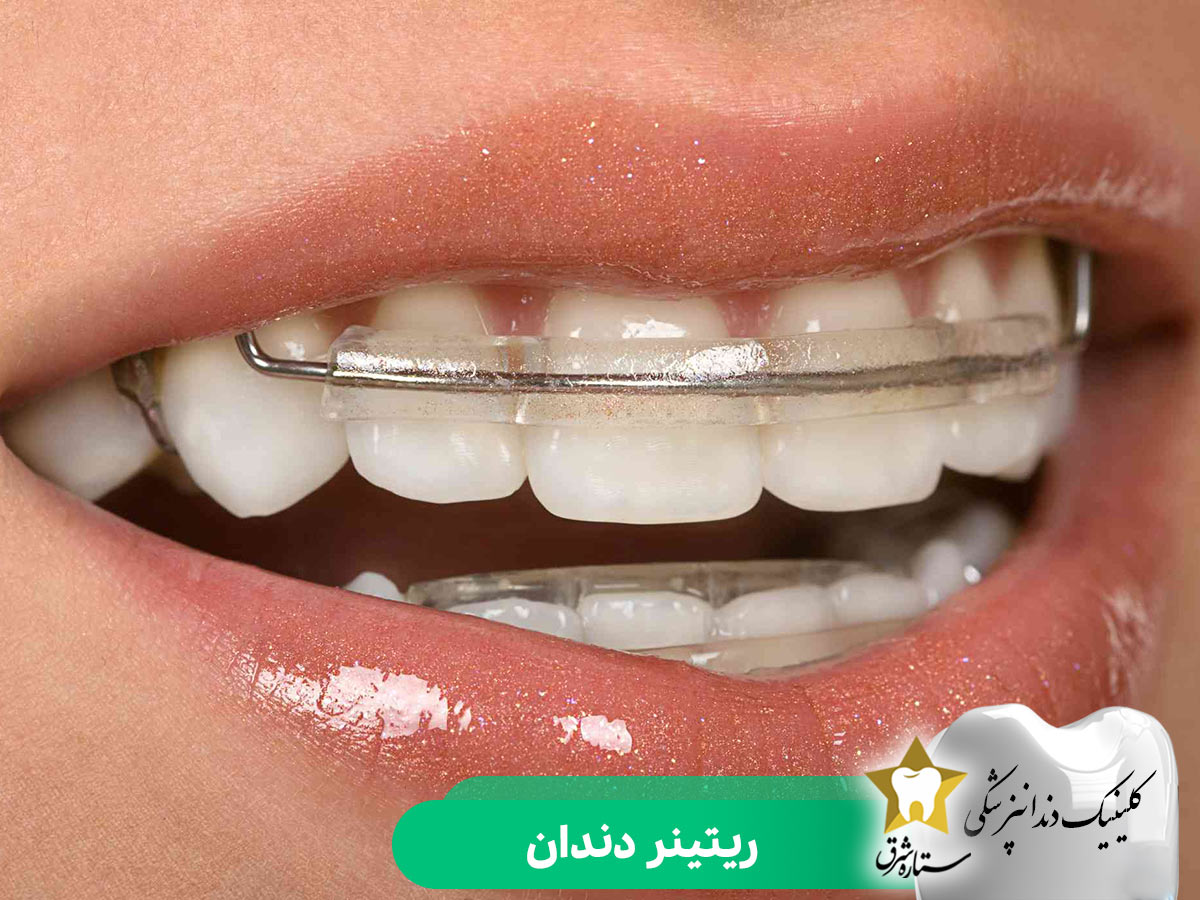 ریتینر دندان