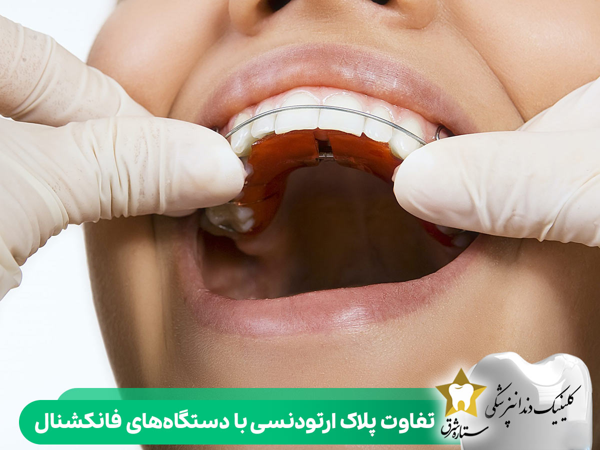 تفاوت پلاک ارتودنسی با دستگاه‌های فانکشنال