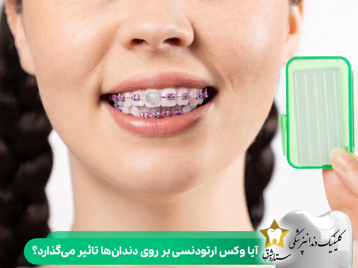 آیا وکس ارتودنسی بر روی دندانها تاثیر میگذارد؟