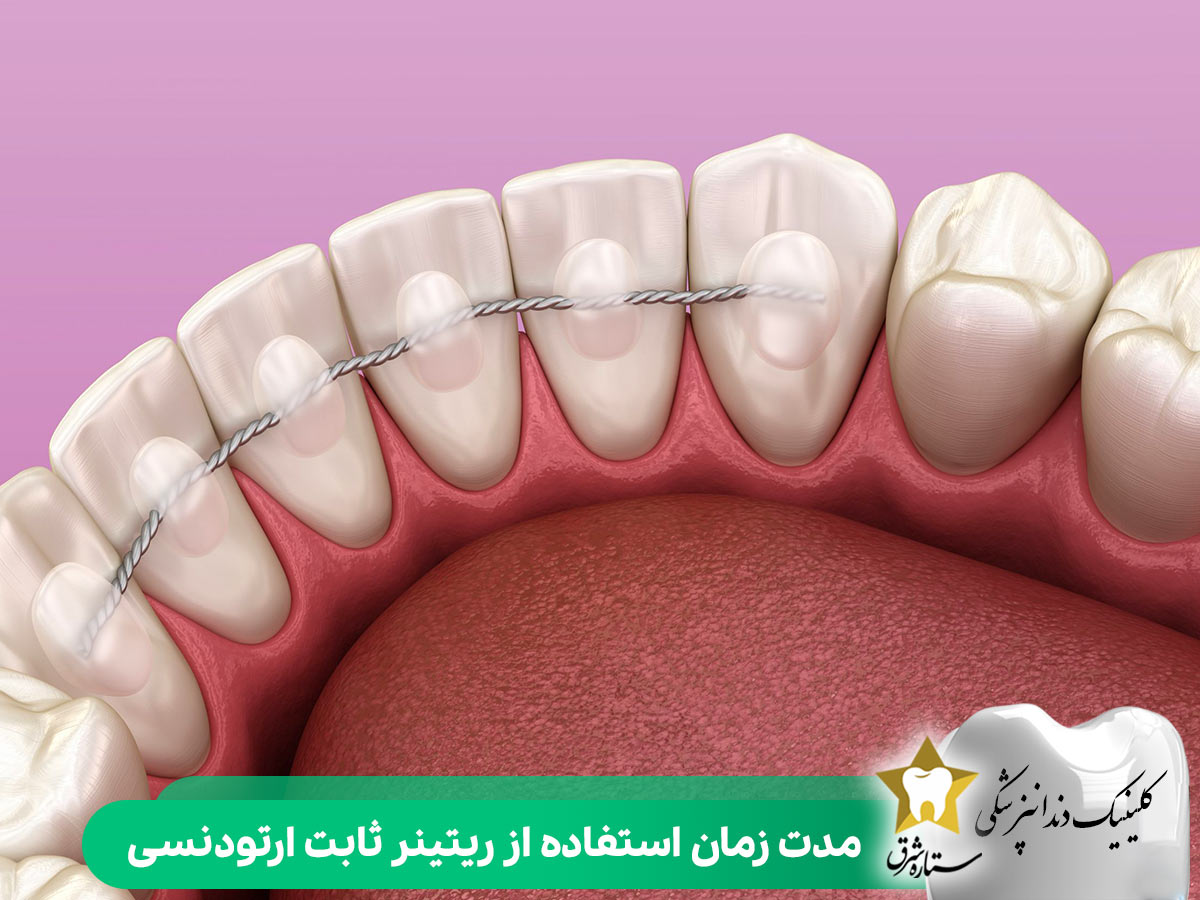 مدت زمان استفاده از ریتینر ثابت ارتودنسی