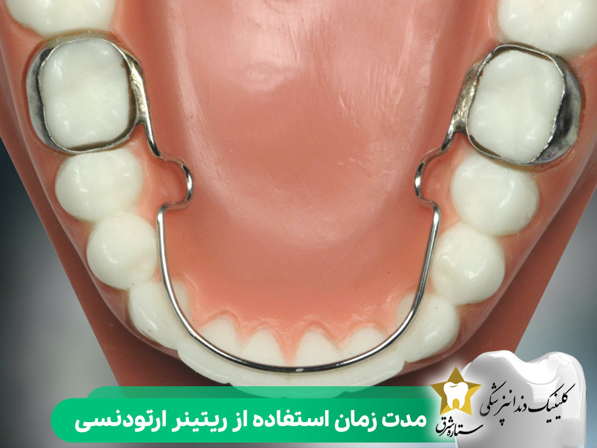 مدت زمان استفاده از ریتینر ارتودنسی