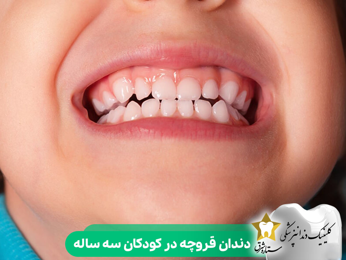 دندان قروچه در کودکان سه ساله
