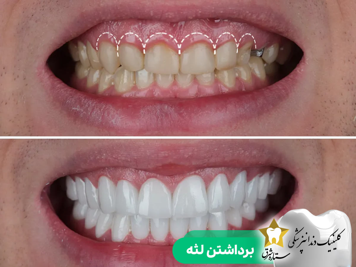 برداشتن لثه در جراحی لیفت لثه