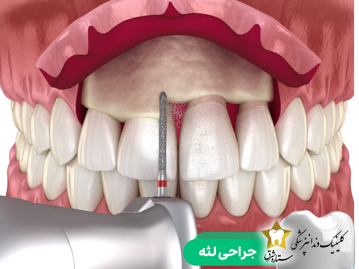 جراحی لثه