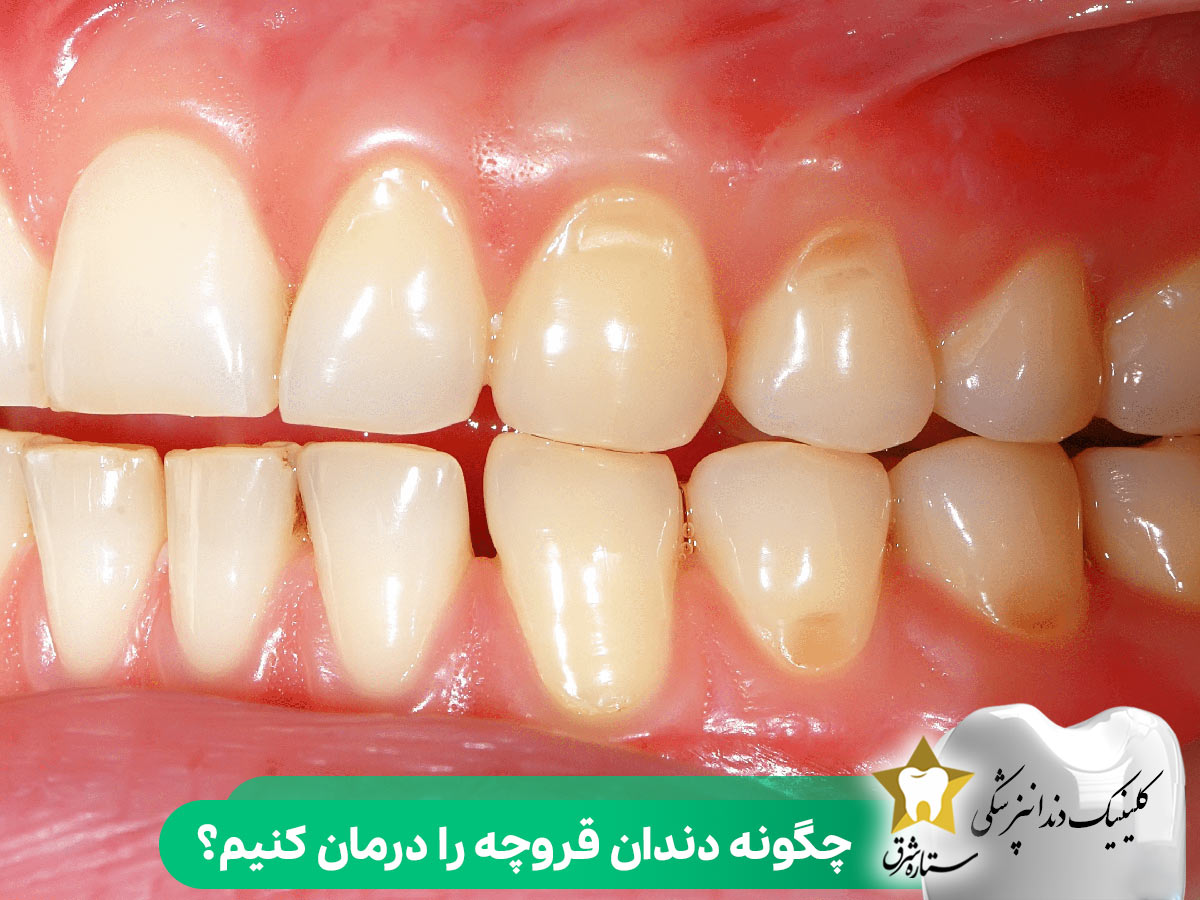 چگونه دندان قروچه را درمان کنیم؟