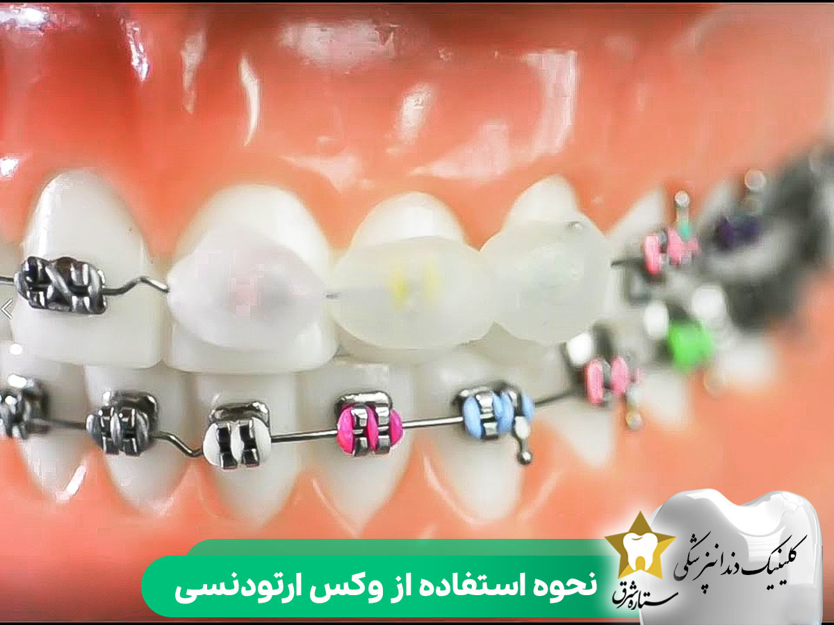 نحوه استفاده از وکس ارتودنسی
