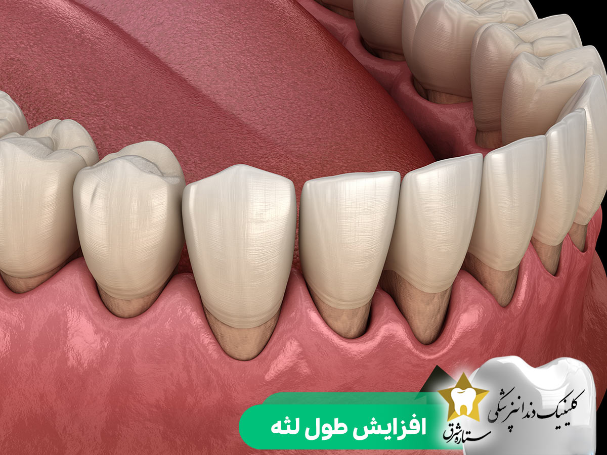 افزایش طول لثهش