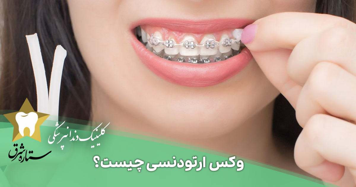 وکس ارتودنسی چیست؟