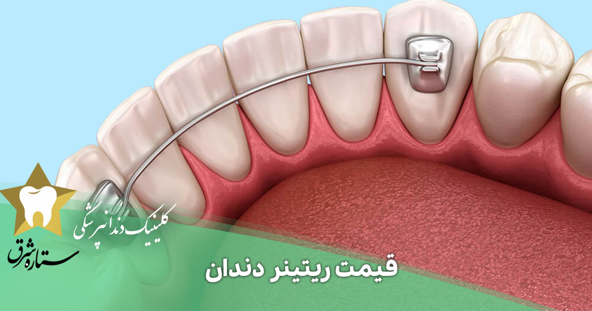 قیمت ریتینر دندان