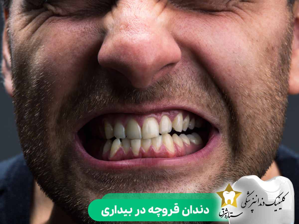دندان قروچه در بیداری