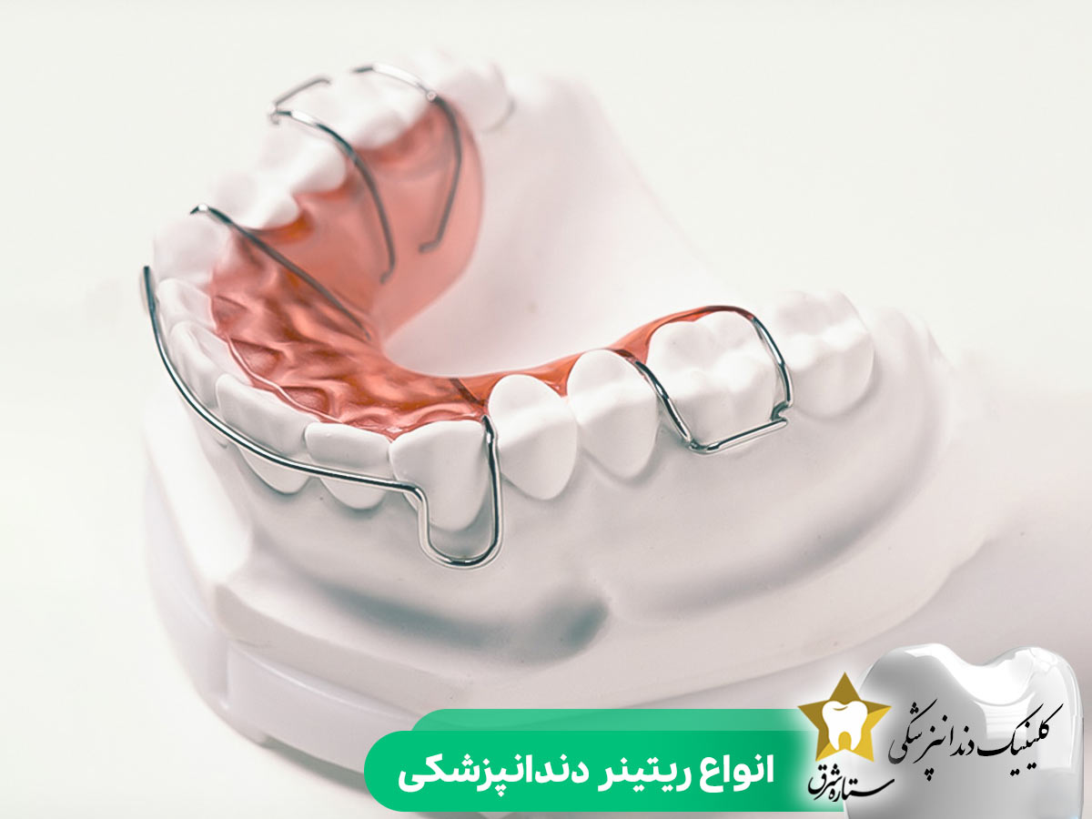 انواع ریتینر دندان