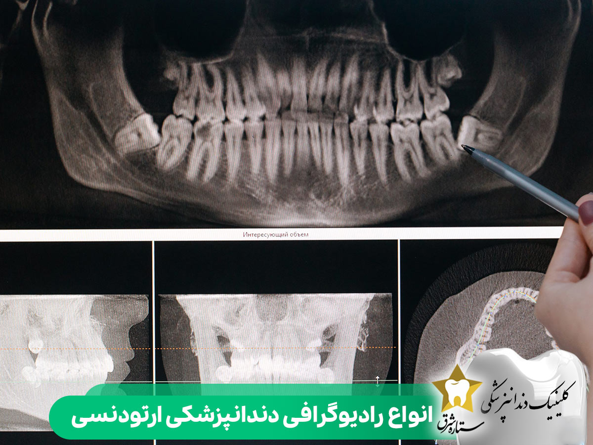 انواع رادیوگرافی دندانپزشکی ارتودنسی