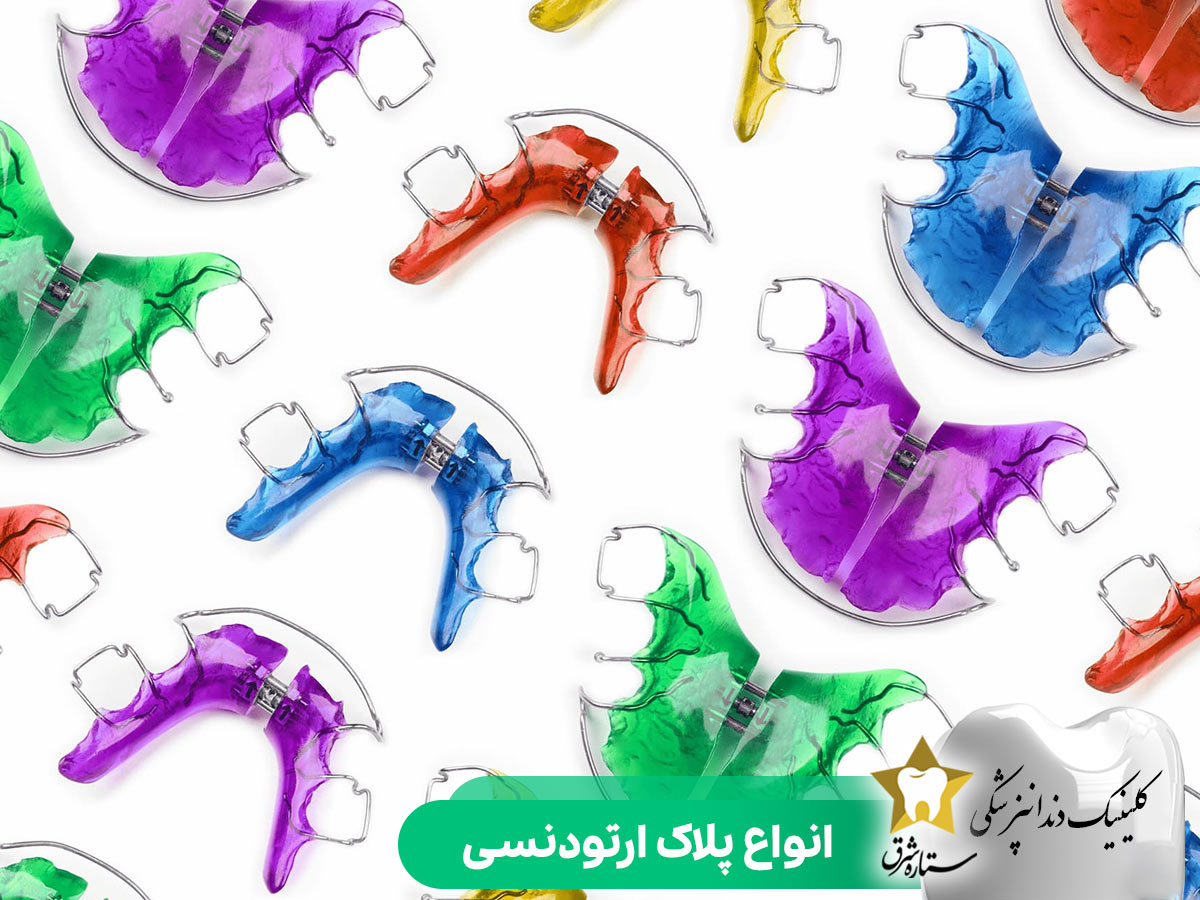 انواع پلاک‌های ارتودنسی