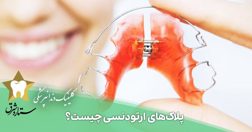 پلاک‌ ارتودنسی چیست؟