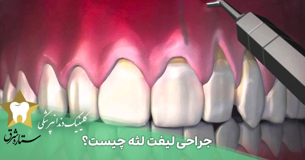 جراحی لیفت لثه چیست؟