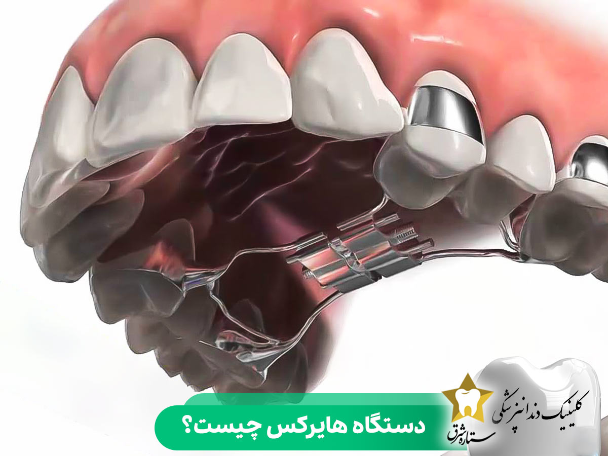 دستگاه هایرکس چیست؟