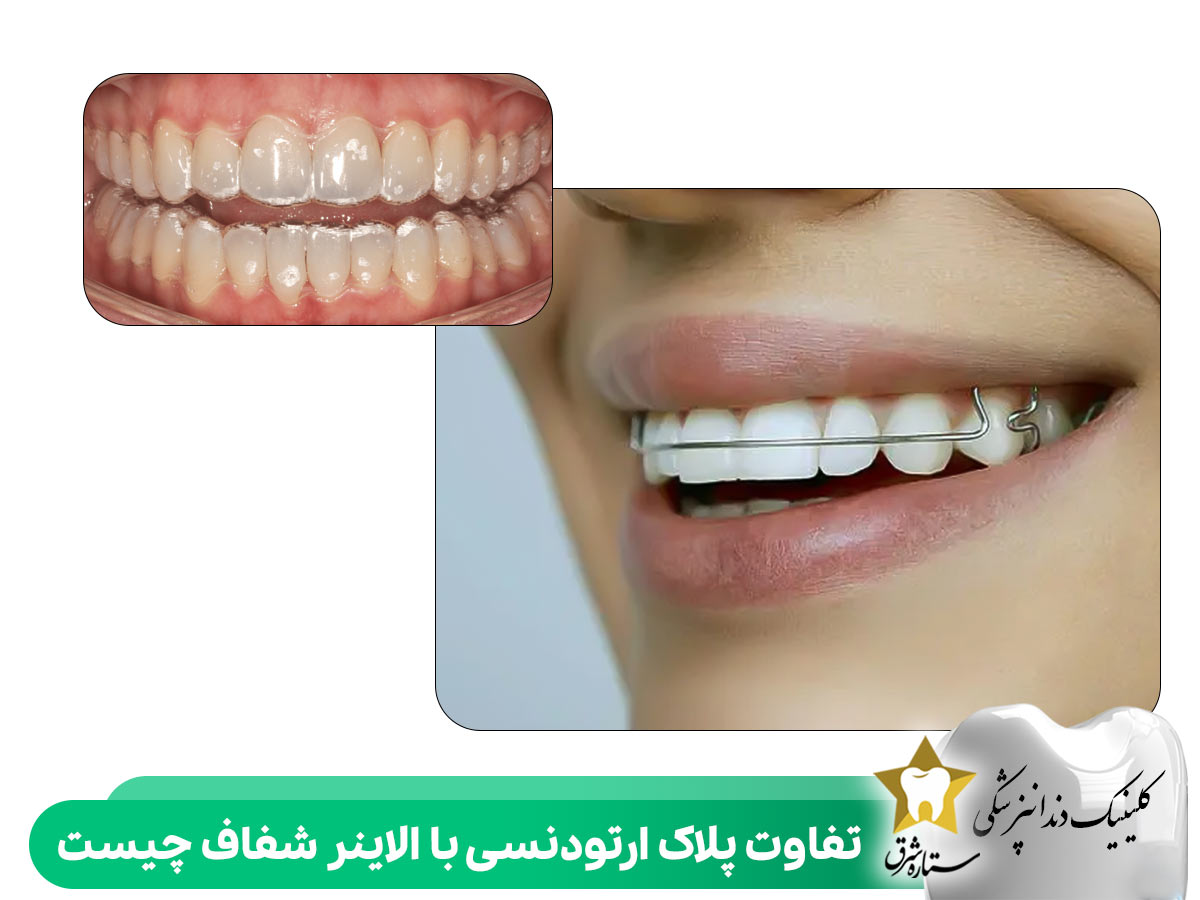 تفاوت پلاک ارتودنسی با الاینر شفاف چیست؟