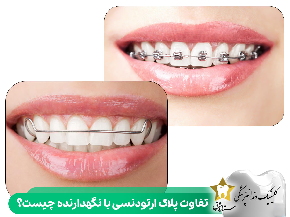 تفاوت پلاک ارتودنسی با نگهدارنده چیست؟