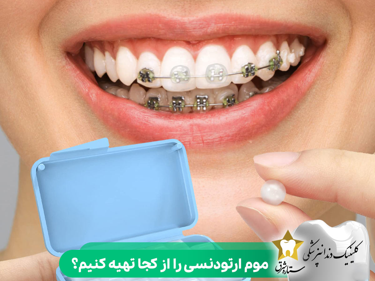 موم ارتودنسی را از کجا تهیه کنیم؟