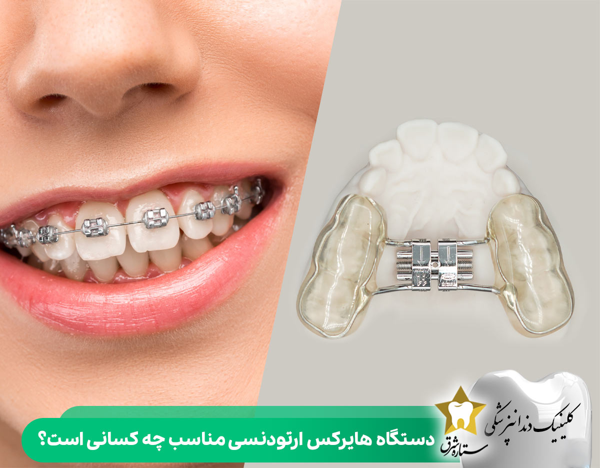 دستگاه هایرکس ارتودنسی مناسب چه کسانی است؟