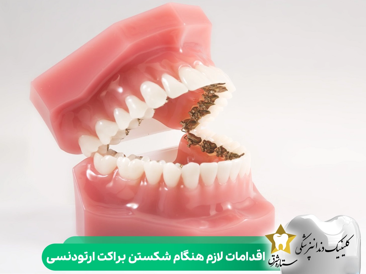 اقدامات لازم هنگام شکستن براکت ارتودنسی