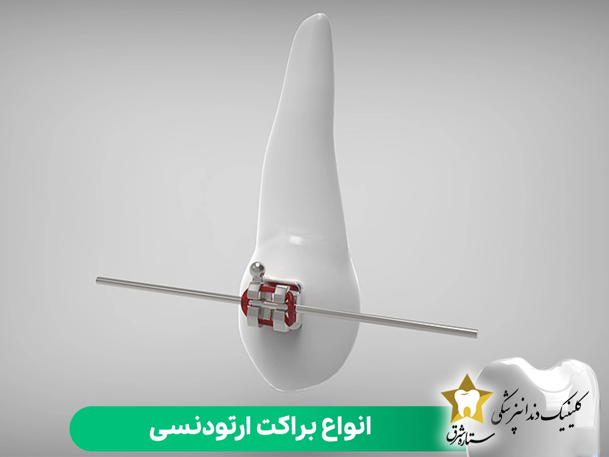 انواع براکت ارتودنسی