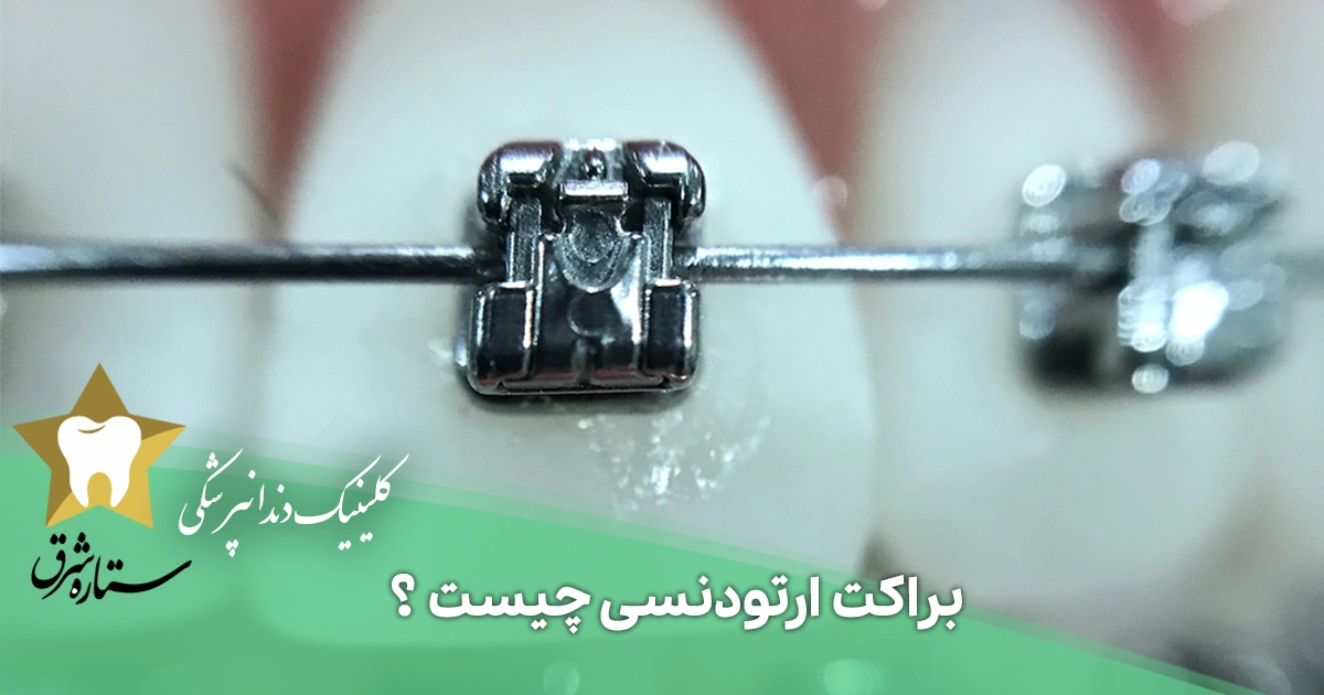 براکت ارتودنسی چیست؟