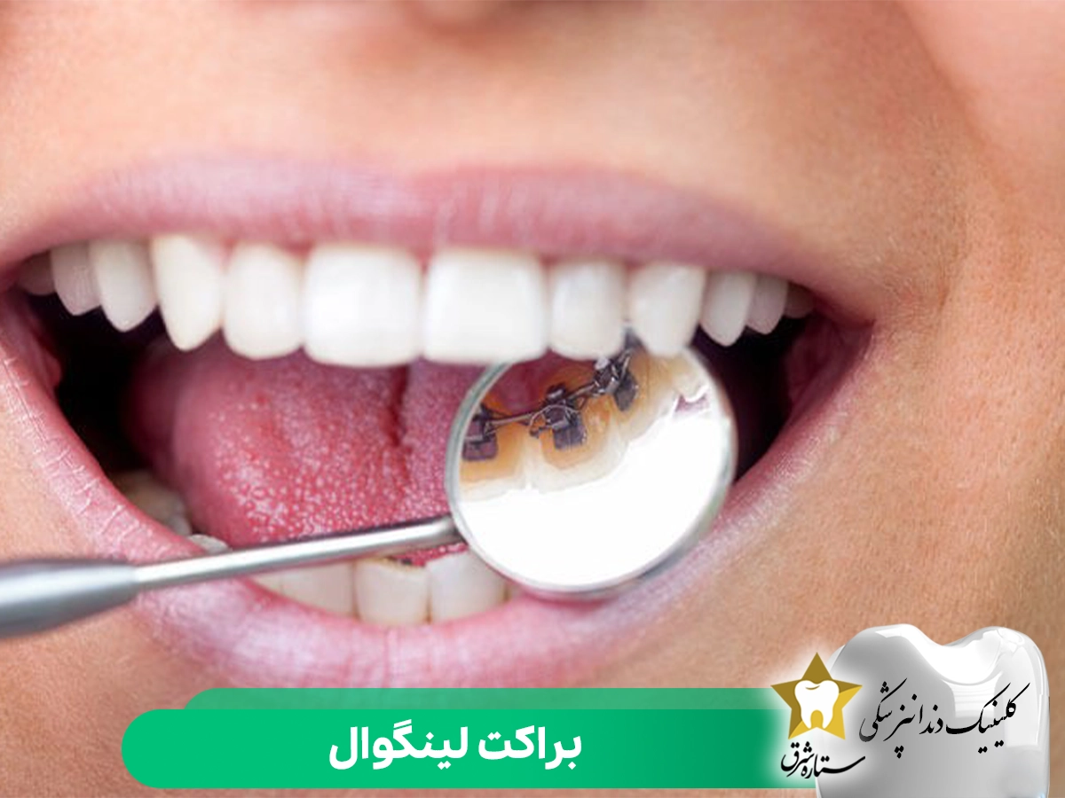 براکت لینگوال