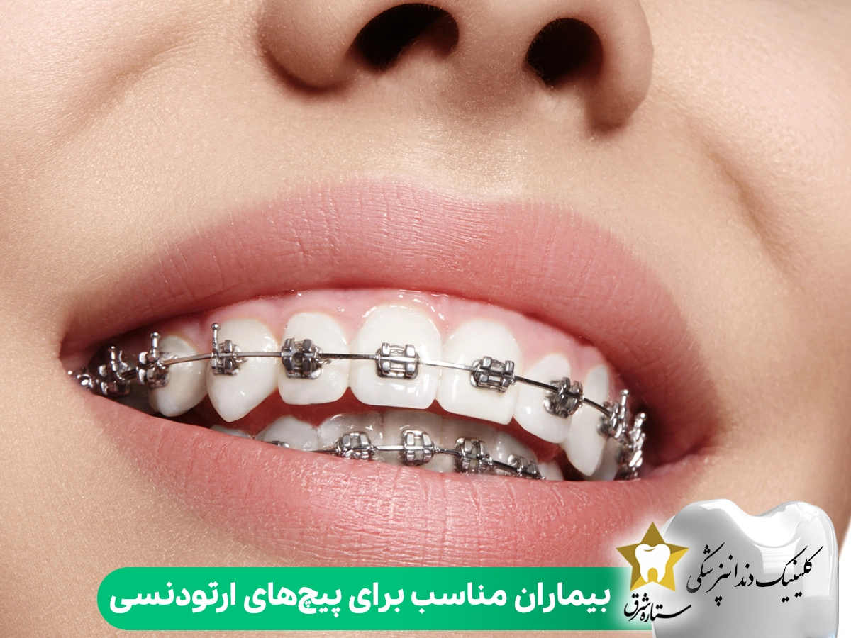 بیماران مناسب برای پیچ‌های ارتودنسی