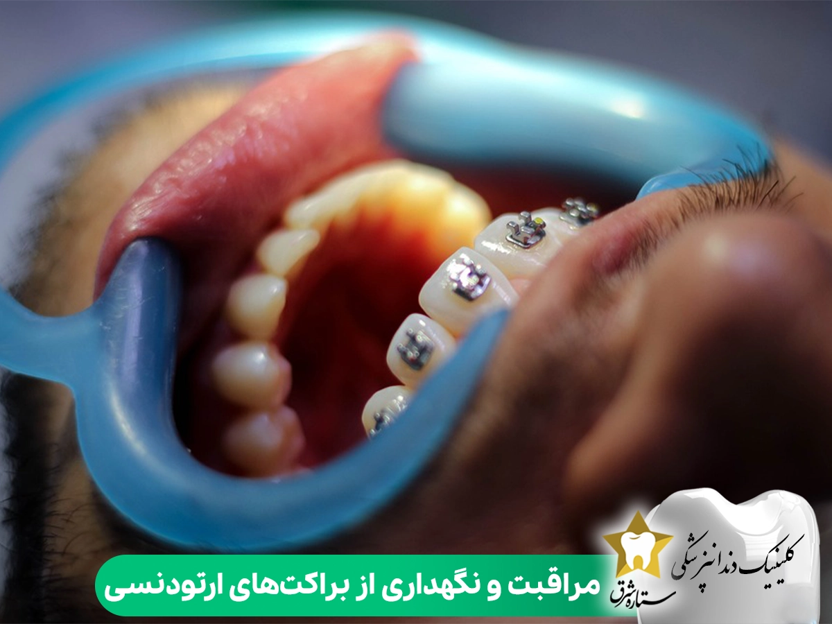 مراقبت و نگهداری از براکتهای ارتودنسی