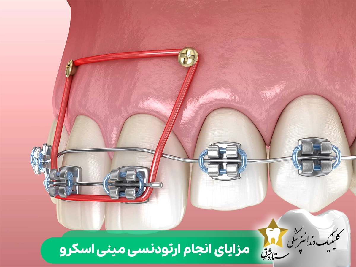مزایای انجام ارتودنسی مینی اسکرو
