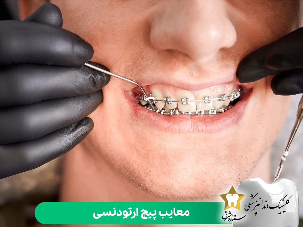 معایب پیچ ارتودنسی