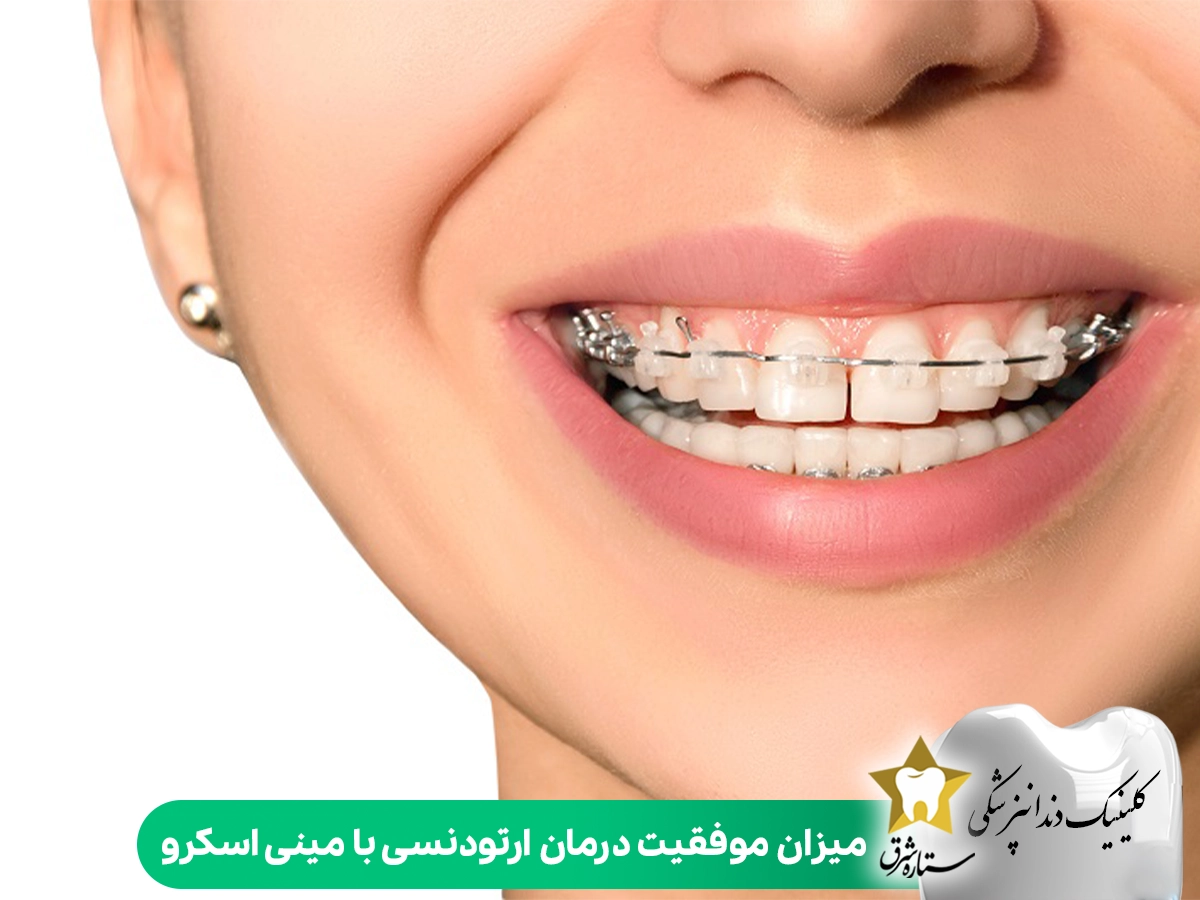 میزان موفقیت درمان ارتودنسی با مینی اسکرو