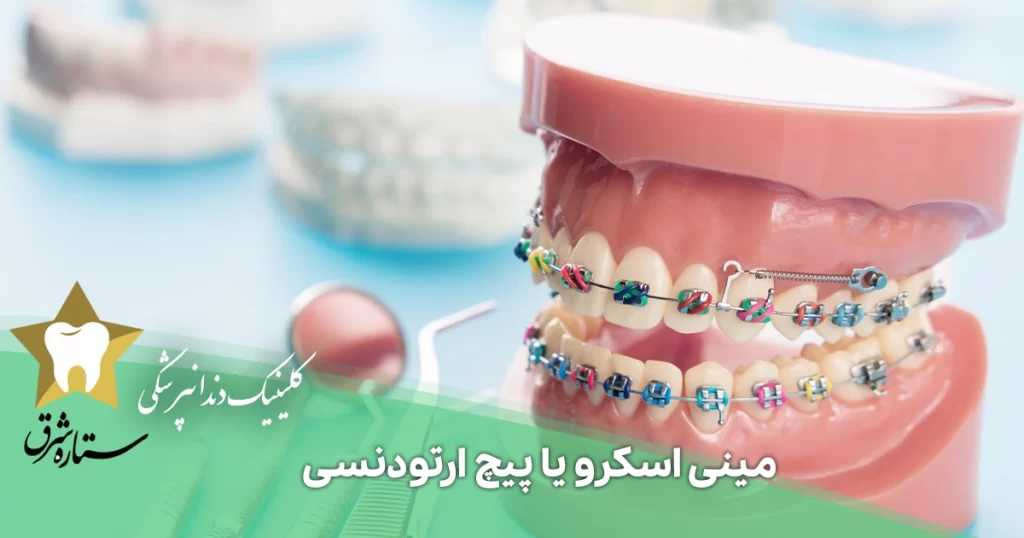 مینی اسکرو یا پیچ ارتودنسی