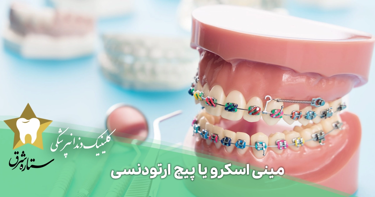 مینی اسکرو یا پیچ ارتودنسی