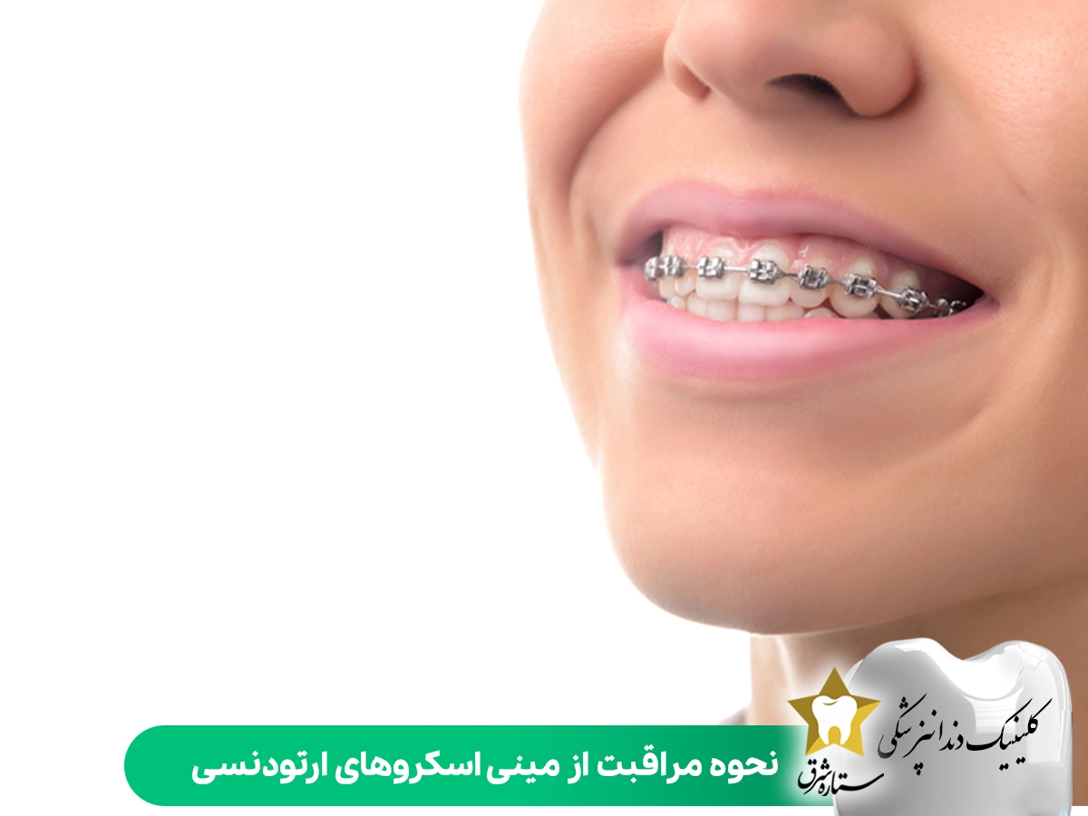 نحوه مراقبت از مینی اسکروهای ارتودنسی