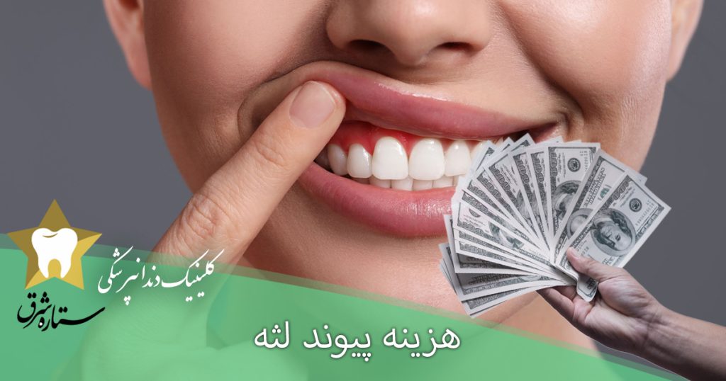 هزینه پیوند لثه