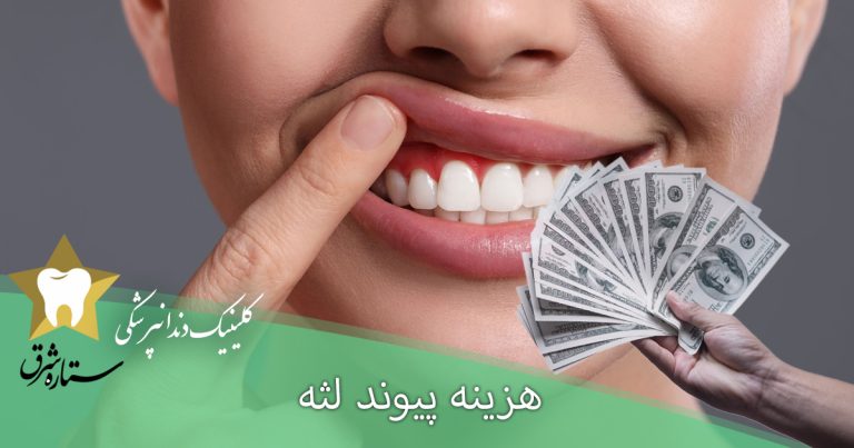 هزینه پیوند لثه