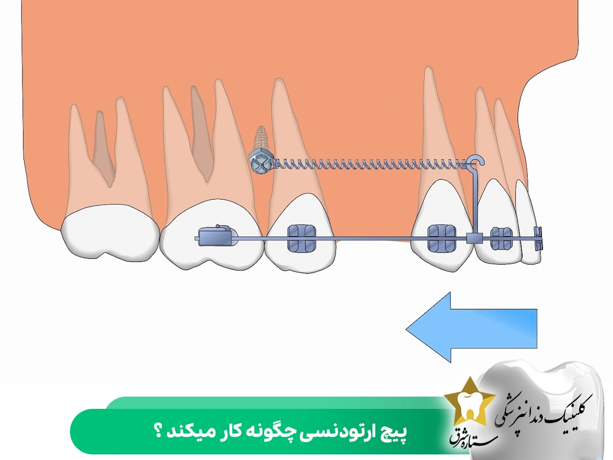 پیچ ارتودنسی چگونه کار می‌کند؟