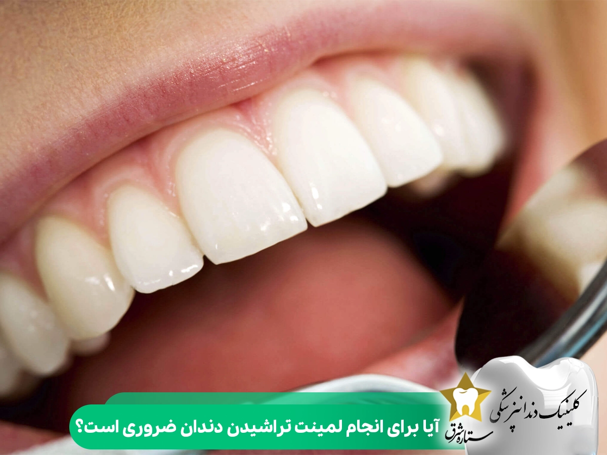 آیا برای انجام لمینت تراشیدن دندان ضروری است؟