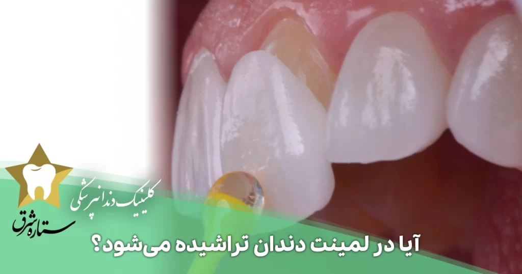 آیا در لمینت دندان تراشیده می‌شود؟