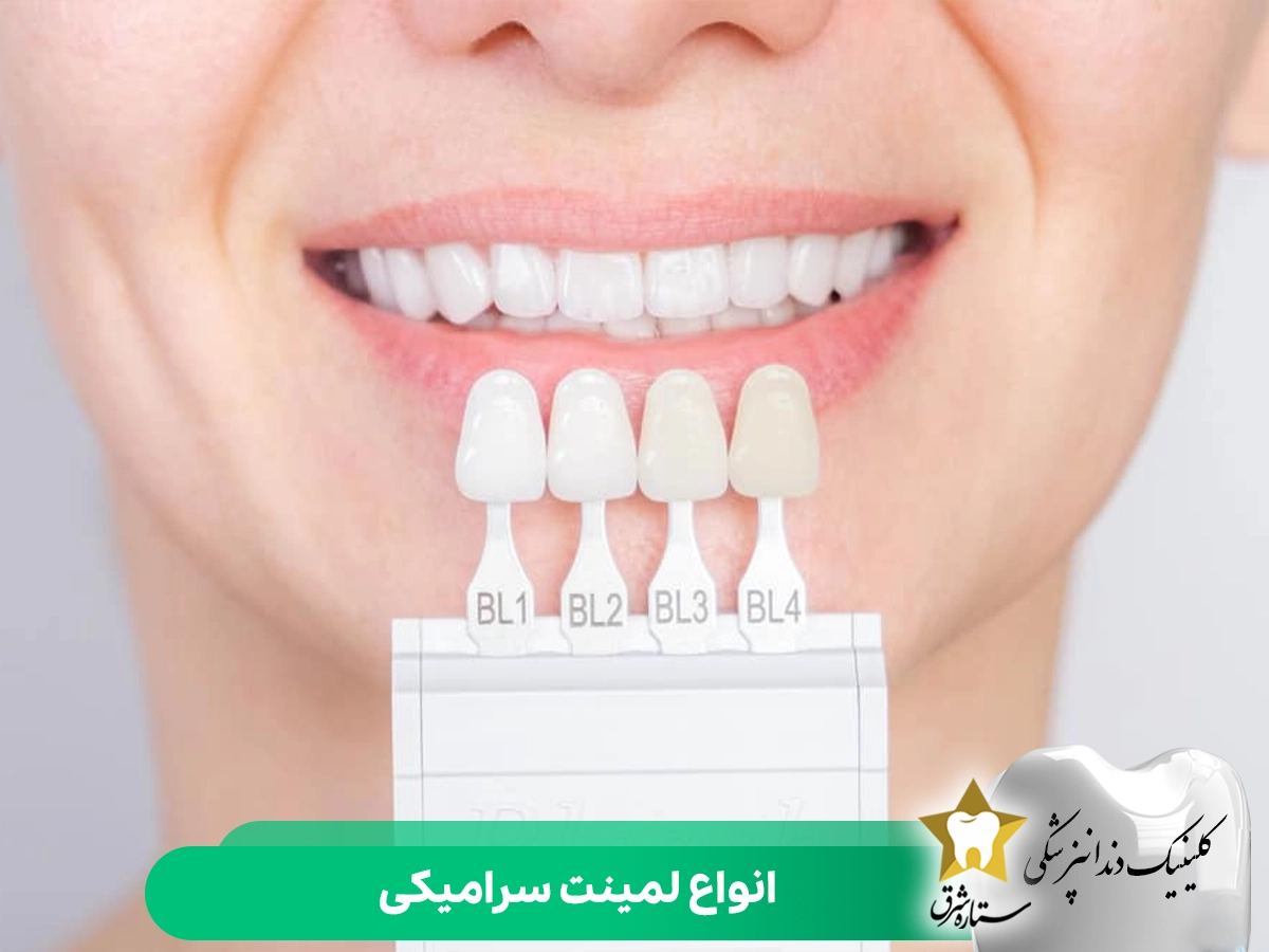 انواع لمینت‌های سرامیکی دندان