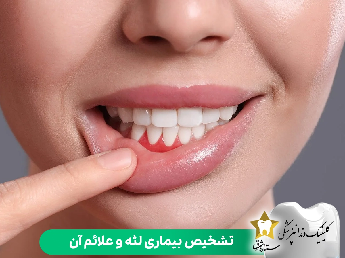 تشخیص بیماری لثه و علائم آن
