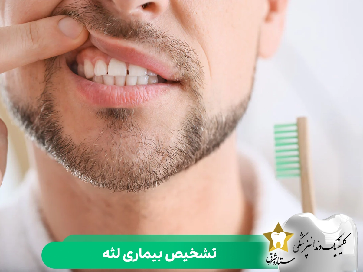 تشخیص بیماری لثه