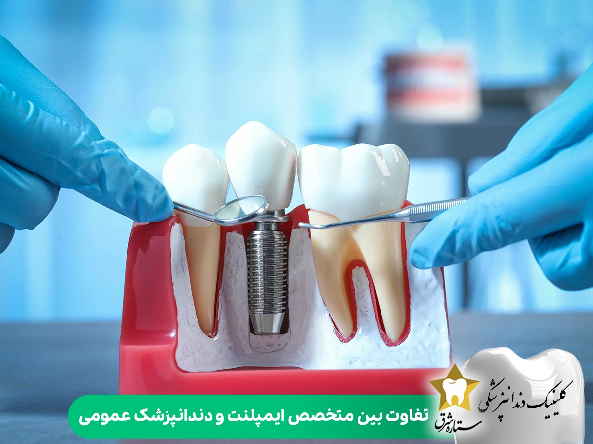 تفاوت بین متخصص ایمپلنت و دندانپزشک عمومی