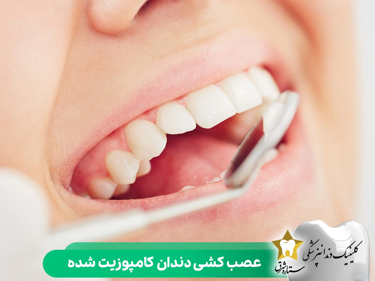 عصب کشی دندان کامپوزیت شده