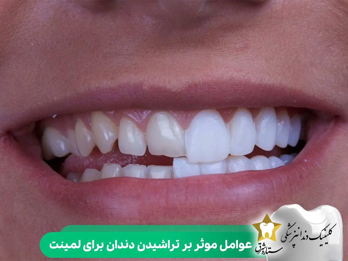عوامل موثر بر تراشیدن دندان برای لمینت